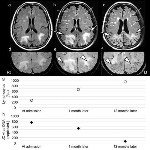 Progressive multifocal leukoencephalopathy associated with systemic lupus erythematosus: longitudinal observation of lymphocytes, JC virus in cerebrospinal fluid, and brain magnetic resonance imaging