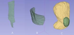 The changes in abdominal wall muscles following incisional hernia wall reconstruction.