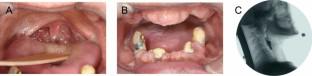 A Case of Dysphagia Rehabilitation in a Patient in the Chronic Stage of Lateral Medullary Syndrome.