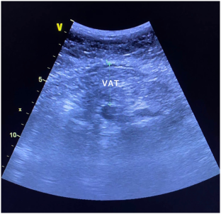 Is phase angle associated with visceral adiposity and cardiometabolic risk in cardiology outpatients?