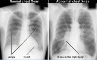 A Bird’s Eye View Approach on the Usage of Deep Learning Methods in Lung Cancer Detection and Future Directions Using X-Ray and CT Images