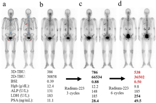 Evaluation of two-dimensional total bone uptake (2D-TBU) and bone scan index (BSI) extracted from active bone metastatic burden on the bone scintigraphy in patients with radium-223 treatment.