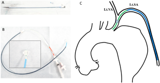 Utilizing a long sheath to minimize atheroma manipulation (minimal manipulation approach) during Zone 1 and 2 thoracic endovascular aortic repair with a shaggy aorta.