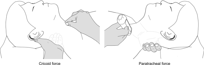 Comparison of the effects of paratracheal pressure and cricoid pressure on placement of the i-gel<sup>®</sup> supraglottic airway: a randomized clinical trial.