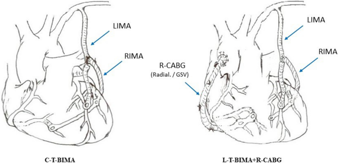 Sequential composite BIMA grafting for 3v-CAD: factors that predict successful outcome of the one-inflow and two-inflow revascularization techniques.