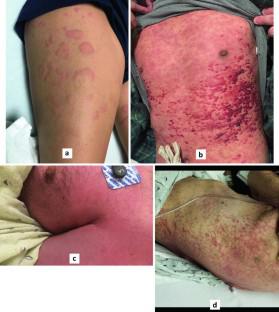 Distinguishing Benign Rashes From Severe Skin Reactions From Anti-Seizure Medications