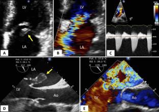 Echocardiography in the Recognition and Management of Mechanical Complications of Acute Myocardial Infarction.