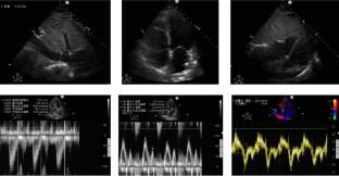 Acute High-Output Heart Failure with Pulmonary Hypertension and Severe Liver Injury Caused by Amlodipine Poisoning: A Case Report.