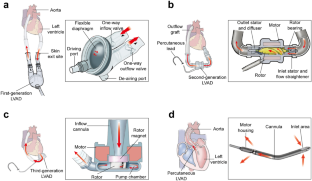 Current status and future directions in pediatric ventricular assist device.