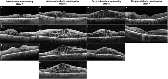 Enhancing Diabetic Macular Edema Treatment Outcomes: Exploring the ESASO Classification and Structural OCT Biomarkers.