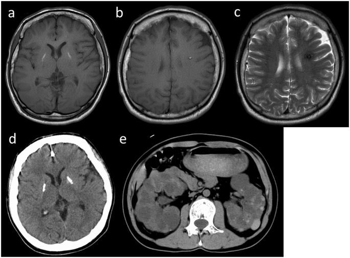 End-stage ADPKD with a low-frequency PKD1 mosaic variant accelerated by chemoradiotherapy