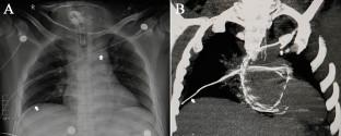 Peripherally inserted central catheter fracture and migration.