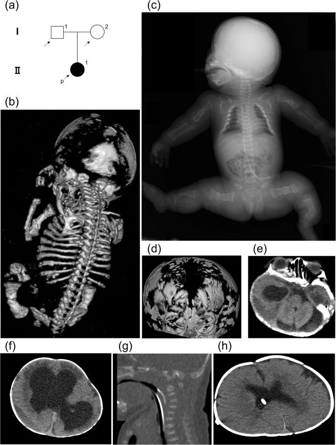 Ventriculosubgaleal shunt placement for hydrocephalus in osteogenesis imperfecta with novel compound heterozygous CRTAP variants