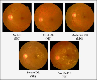 Classification of diabetic retinopathy severity level using deep learning