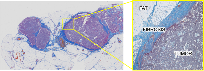 Tumor-associated fibrosis: a unique mechanism promoting ovarian cancer metastasis and peritoneal dissemination.