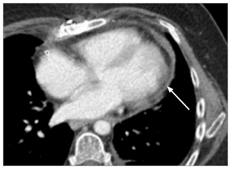 Successful Suture-Free Repair of Left Ventricular Rupture Using the EVARREST Patch.