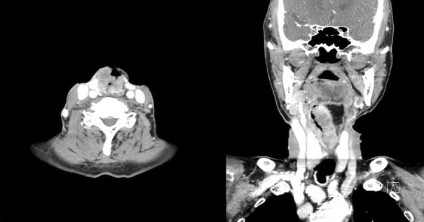 [Gastro-Colo-Cutaneous Fistula Occurring After Percutaneous Endoscopic Gastrostomy Procedure].