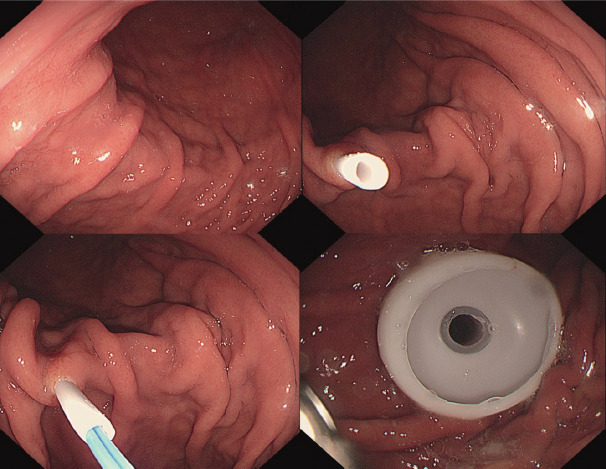 [Gastro-Colo-Cutaneous Fistula Occurring After Percutaneous Endoscopic Gastrostomy Procedure].