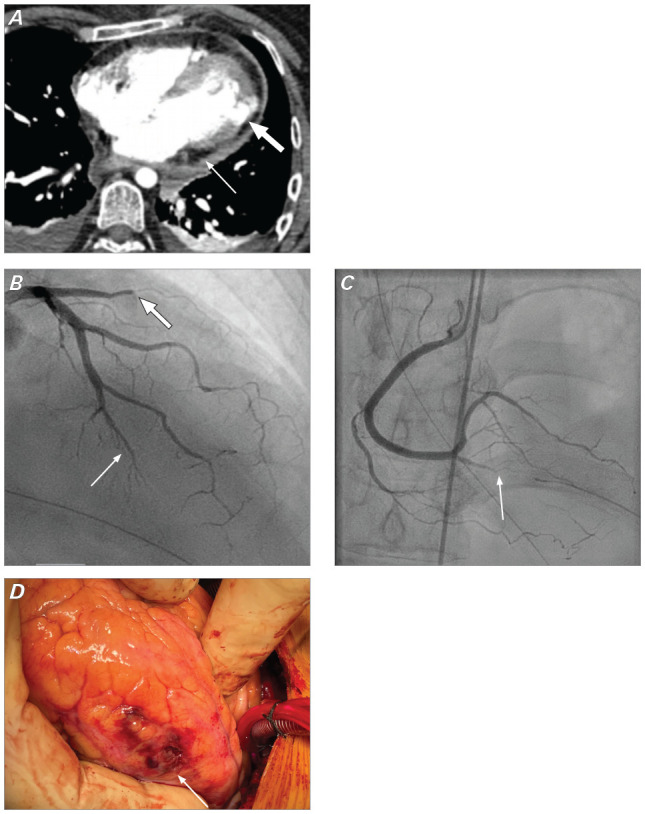Successful Suture-Free Repair of Left Ventricular Rupture Using the EVARREST Patch.