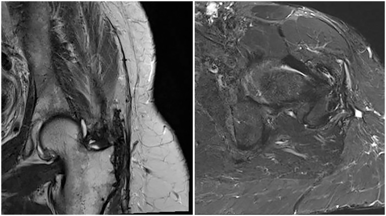 Gluteus maximus tendon transfer as a salvage option for painful chronic hip abductor insufficiency: clinical and MRI results with a minimum follow-up of 24 months.