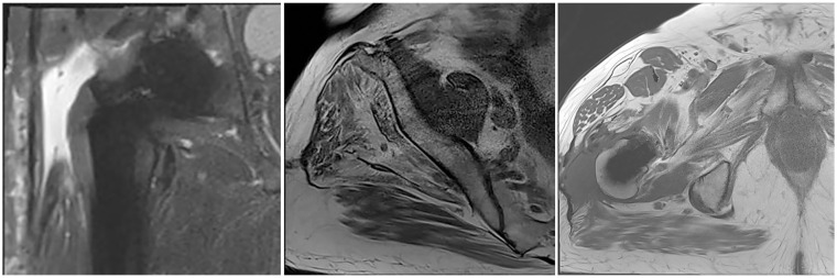 Gluteus maximus tendon transfer as a salvage option for painful chronic hip abductor insufficiency: clinical and MRI results with a minimum follow-up of 24 months.