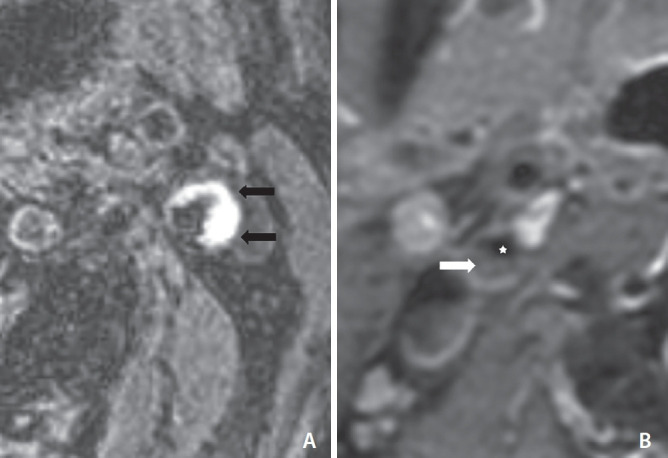 Findings of Angiography and Carotid Vessel Wall Imaging Associated with Post-Procedural Clinical Events after Carotid Artery Stenting.