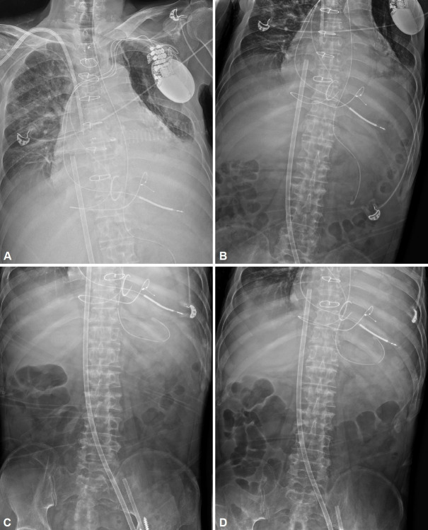Delayed Gastric Perforation by Nasogastric Tube: A Case Report.