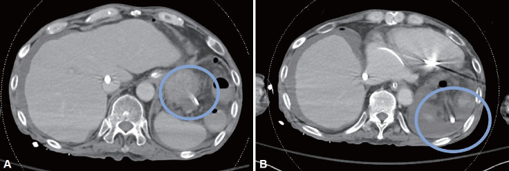 Delayed Gastric Perforation by Nasogastric Tube: A Case Report.