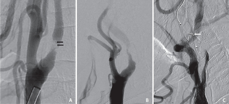 Findings of Angiography and Carotid Vessel Wall Imaging Associated with Post-Procedural Clinical Events after Carotid Artery Stenting.