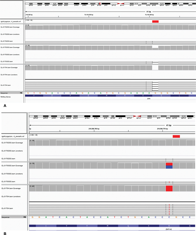 Maternal Uniparental Isodisomy of Chromosome 2 Leading to Homozygous Variants in <i>SPR</i> and <i>ZNF142</i> : A Case Report and Review of the UPD2 Literature.