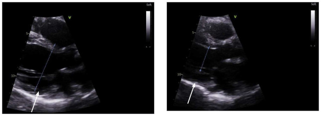 Successful Suture-Free Repair of Left Ventricular Rupture Using the EVARREST Patch.