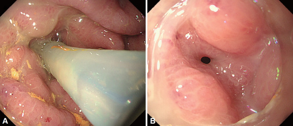 Delayed Gastric Perforation by Nasogastric Tube: A Case Report.