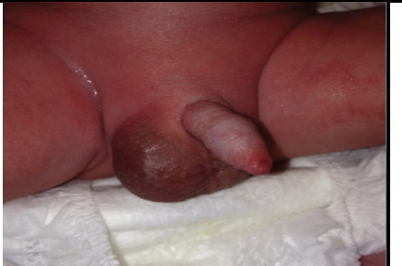 MIS-C Like Features in a Patient of Atypical Kawasaki Disease: A Case Report.