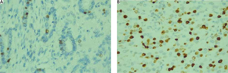 Evaluation of cleaved caspase-3 and Ki-67 index on diagnostic biopsy in response to neoadjuvant chemotherapy in the context of post-treatment tumour ypT stage, ypN stage, grade, and molecular subtype.