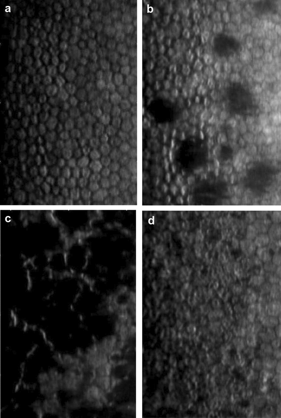 Deep learning for detection of Fuchs endothelial dystrophy from widefield specular microscopy imaging: a pilot study.