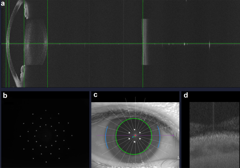 Evaluation of a new dynamic real-time visualization 25 kHz swept-source optical coherence tomography based biometer.