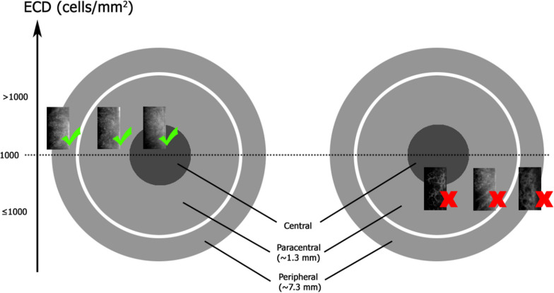 Deep learning for detection of Fuchs endothelial dystrophy from widefield specular microscopy imaging: a pilot study.
