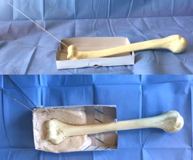 A new configuration of lateral-pin fixation for pediatric supracondylar humeral fracture: A biomechanical analysis.