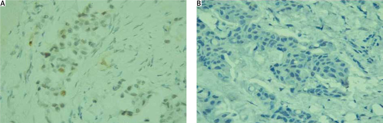 Evaluation of cleaved caspase-3 and Ki-67 index on diagnostic biopsy in response to neoadjuvant chemotherapy in the context of post-treatment tumour ypT stage, ypN stage, grade, and molecular subtype.