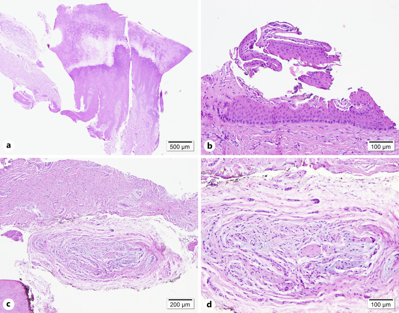Expanding the Differential Diagnosis of the Painful Nail: A Case of an Onychopapilloma with Neuroma.