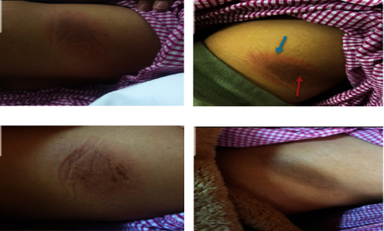 A Saudi Woman with Ceftriaxone Induced Fixed Drug Eruption.
