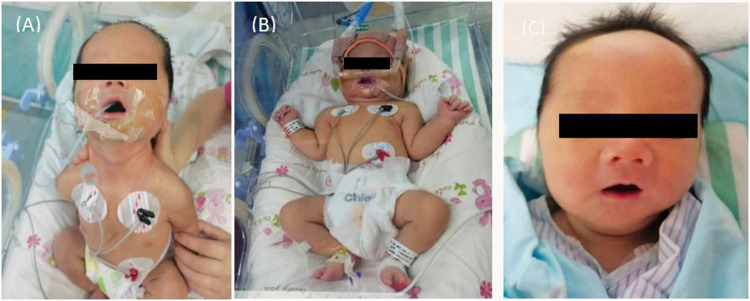 Transient Neonatal Myasthenia Gravis Born to a Mother with Asymptomatic MG: A Case Report.