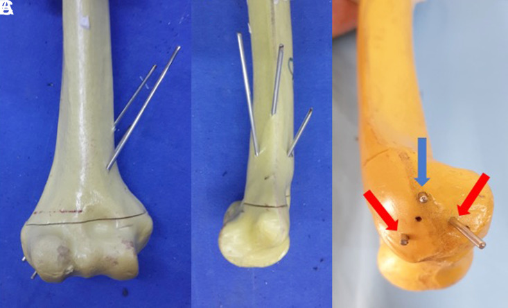 A new configuration of lateral-pin fixation for pediatric supracondylar humeral fracture: A biomechanical analysis.