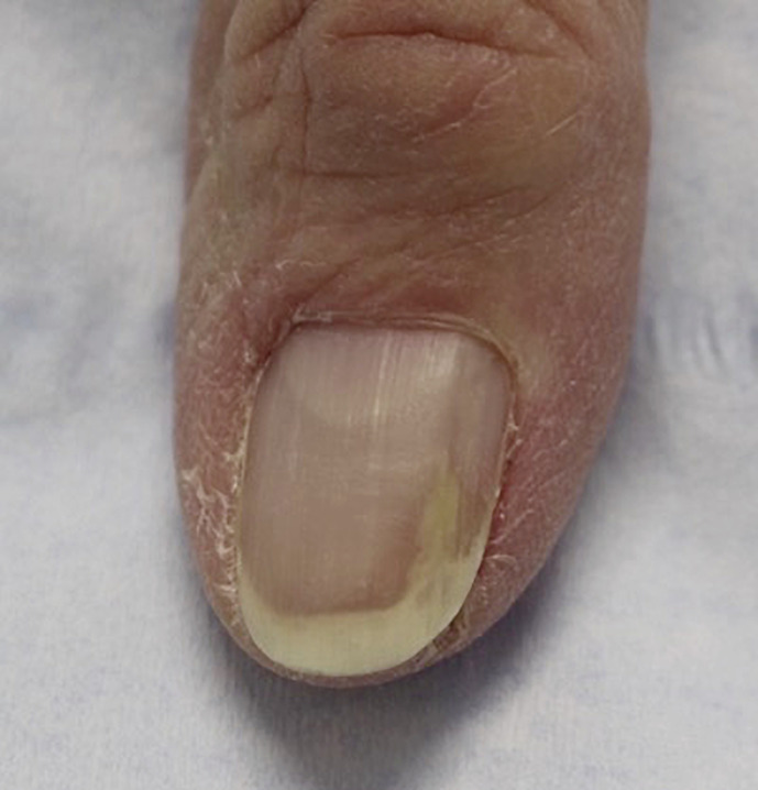 Expanding the Differential Diagnosis of the Painful Nail: A Case of an Onychopapilloma with Neuroma.