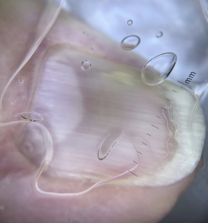 Expanding the Differential Diagnosis of the Painful Nail: A Case of an Onychopapilloma with Neuroma.