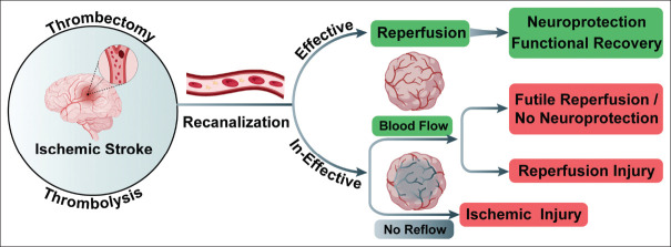 Impacts of futile reperfusion and reperfusion injury in acute ischemic stroke.