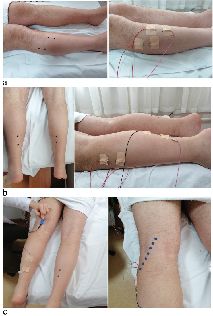 The Diagnostic Role of Adding the Hoffman Reflex for L5 Radiculopathy in the Electrodiagnostic Laboratory: A Cross-sectional Study.
