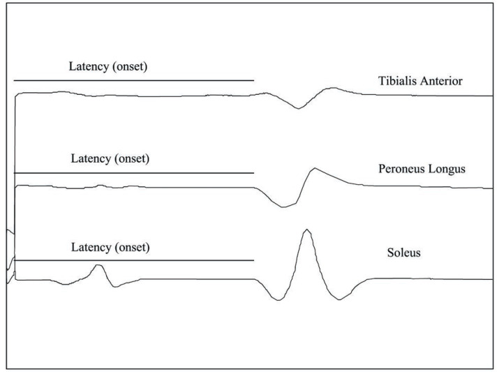 The Diagnostic Role of Adding the Hoffman Reflex for L5 Radiculopathy in the Electrodiagnostic Laboratory: A Cross-sectional Study.