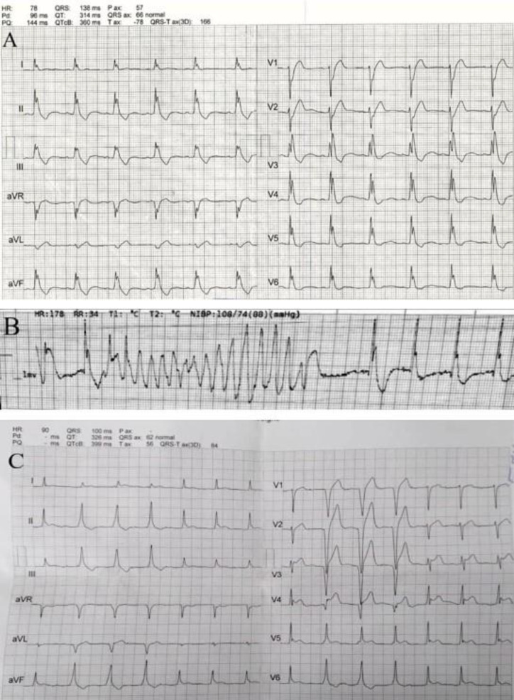 The association between GJB2 gene (producing Cx26 protein) and the ventricular storm: A case report.
