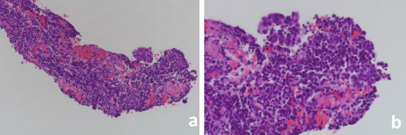 Bilateral Iris Metastasis in a Patient with Small Cell Lung Carcinoma: A Case Report.